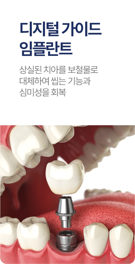디지털 가이드 임플란트