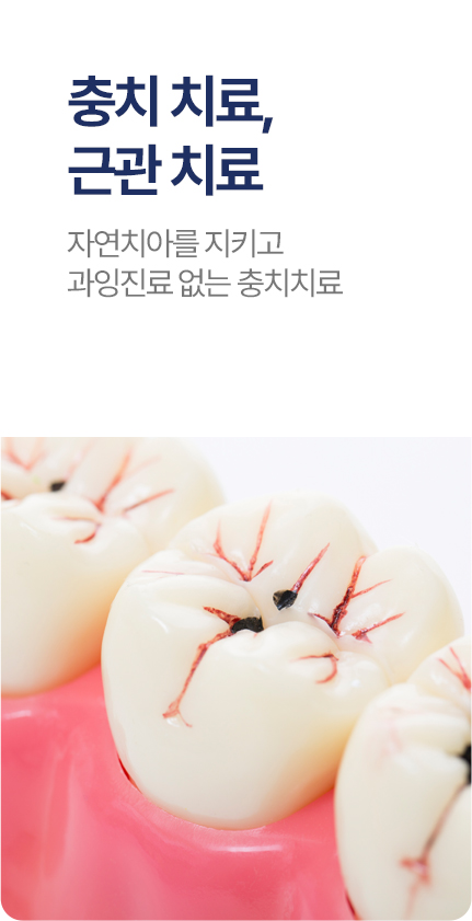 충치 치료, 근관치료